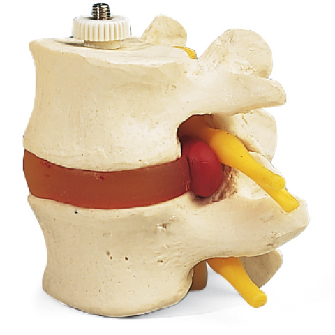 A76/9 - 2 VERTEBRE LOMBARI CON ERNIA DEL DISCO, MONTAGGIO ELASTICO